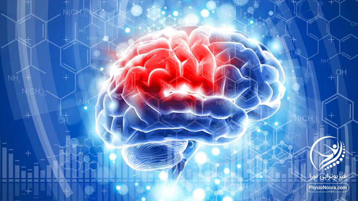 درمان سکته مغزی چیست؟