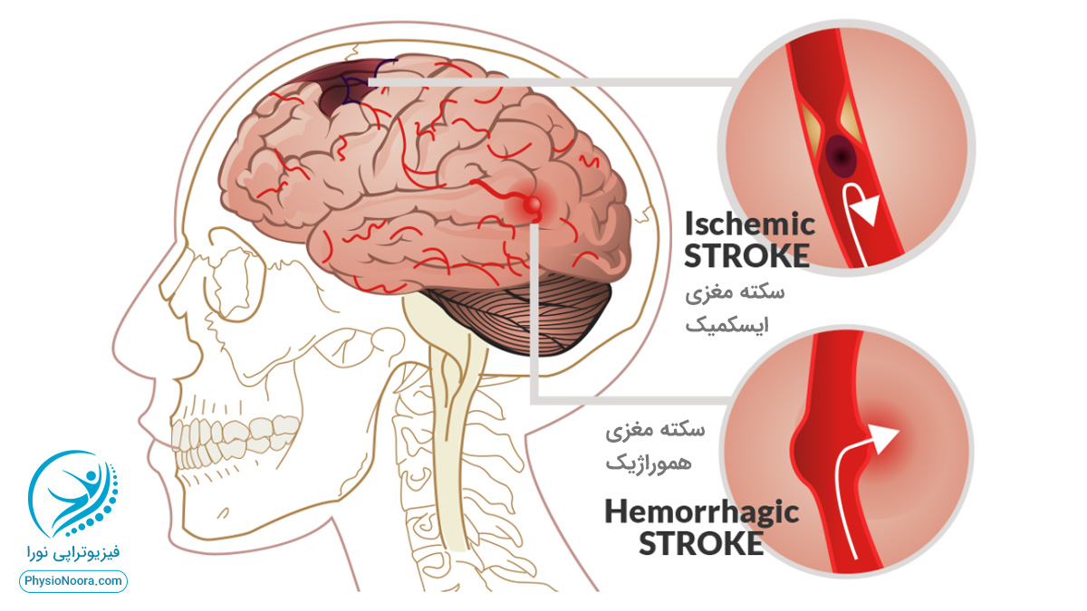 سکته مغزی یا stroke چیست؟
