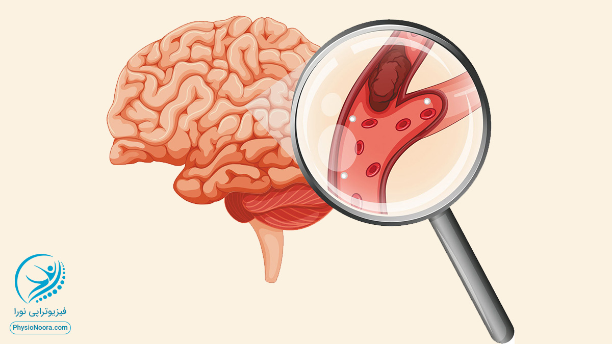 علت اصلی سکته مغزی چیست؟